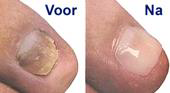 Nagel reperatie Nagel reperatie